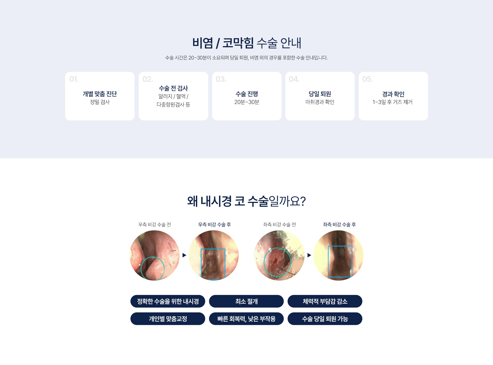 비염/코막힘 클리닉
